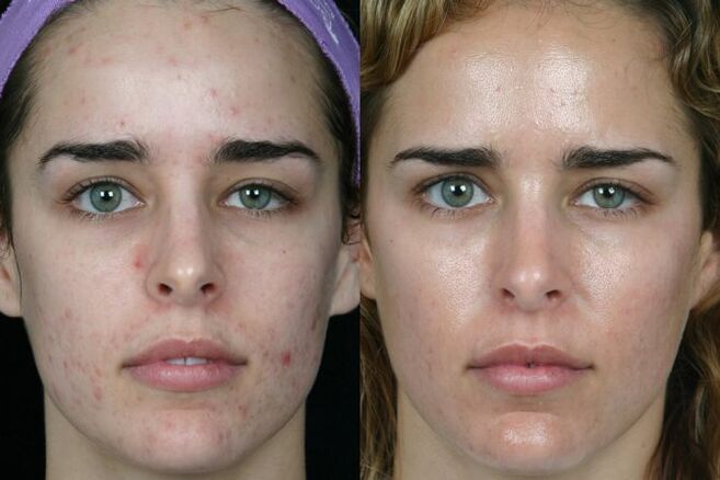 Molienda láser de la piel de la cara antes y después